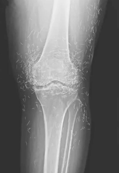 В ногах женщины, лечившейся от остеоартрита, обнаружили сотни золотых нитей