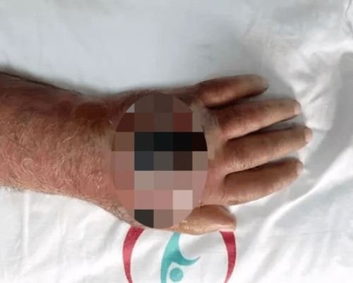 Владелец магазина, укушенный грабителем, чуть не лишился руки